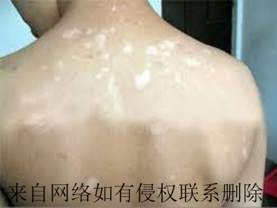 白癜风患者日常护理注重什么