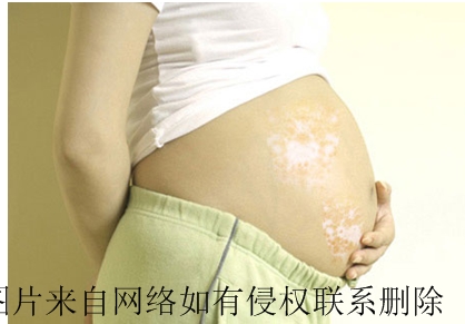 孕妇患白癜风要注意什么常识
