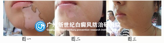 李同学 16岁 下颌、耳后身上多处白斑3年多