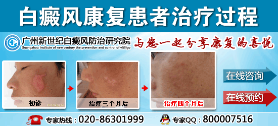 杨先生 27岁 左脸白斑半年多