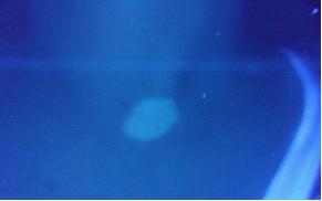 患者前颈部片状白斑,硬币大小,边缘清晰