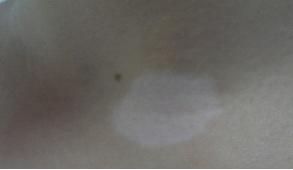 初诊时肉眼观察,患者前颈部片状白斑清晰可见