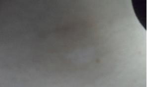 经过一个月治疗后,白斑明显变淡