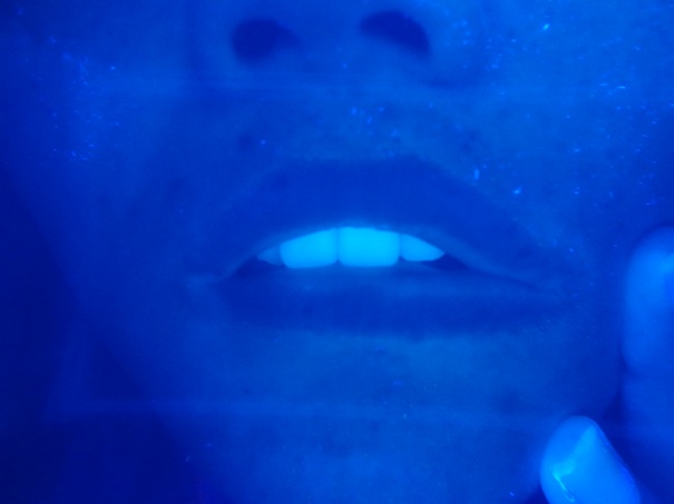 治疗前,伍德灯检查显示:患者白斑成分散型分布