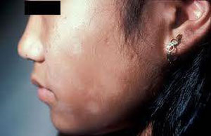 小儿眼周围白癜风不治疗会有哪些伤害 小儿眼周围白癜风不治疗会有哪些伤害