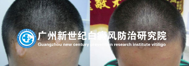 头部白癜风患者该如何洗头呢 头部白癜风患者该如何洗头呢