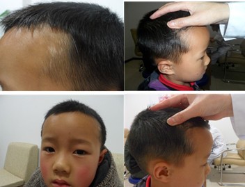 广州权威白癜风专家讲解白癜风症状 广州权威白癜风专家讲解白癜风症状