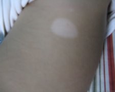 白斑病如何治疗 白斑病如何治疗