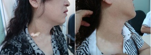 白癜风严重程度介绍分析 白癜风严重程度介绍分析