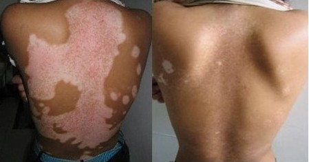 早期白癜风的表现怎样的 早期白癜风的表现怎样的