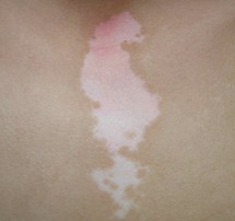 老人白殿风遗传吗 老人白殿风遗传吗