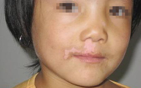 白癜风图片 白癜风图片