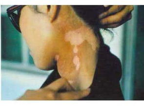 白癜风图片 白癜风图片