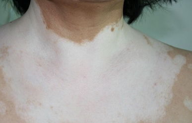 白癜风图片 白癜风图片