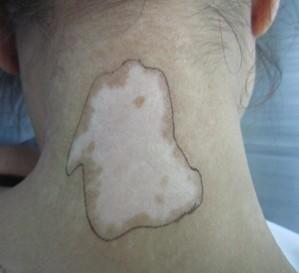 白癜风图片 白癜风图片