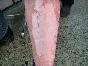 白癜风图片 白癜风图片