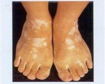 脚部白癜风的原因有哪些